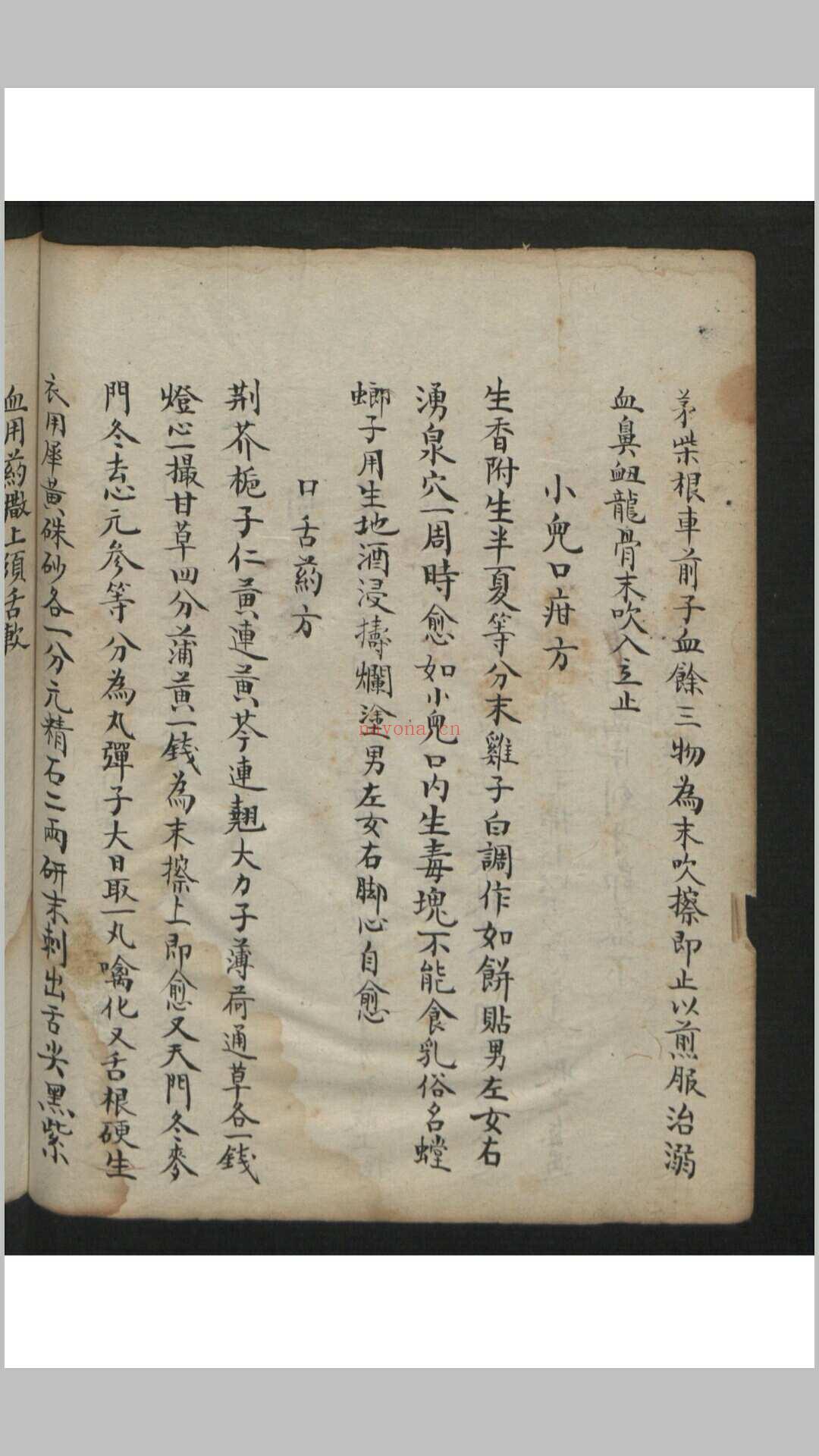 王维德 罗湖 外科证治全生集 , 1886