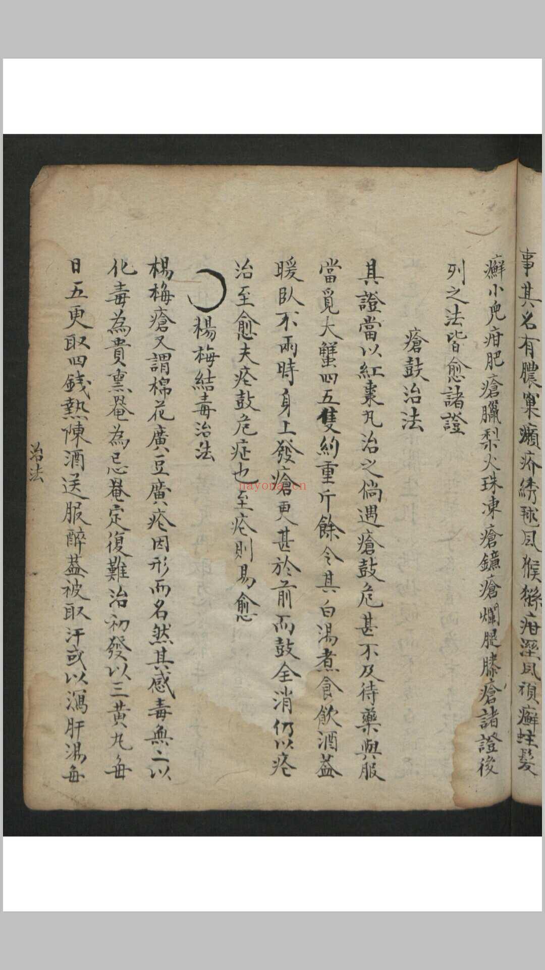 王维德 罗湖 外科证治全生集 , 1886