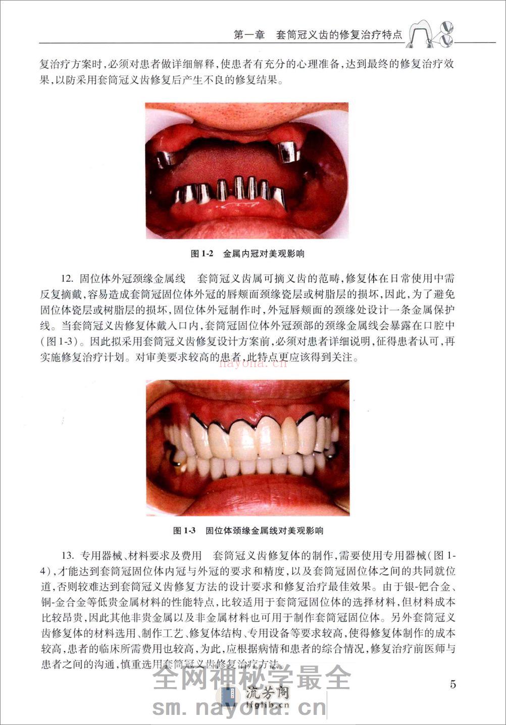 套筒冠义齿 - 第13页预览图