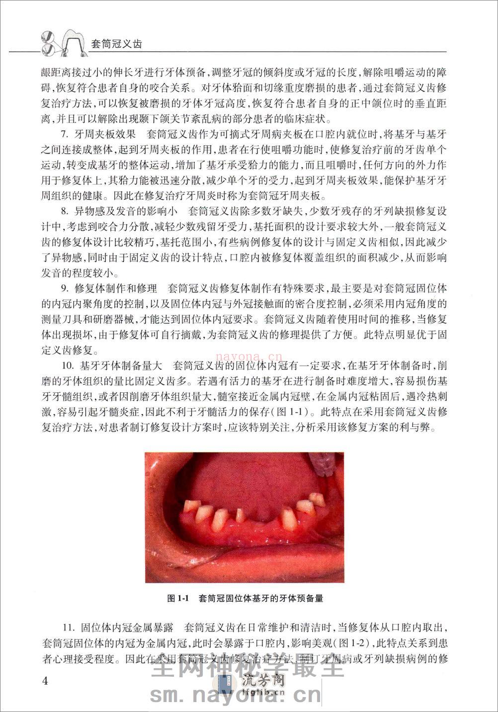 套筒冠义齿 - 第12页预览图