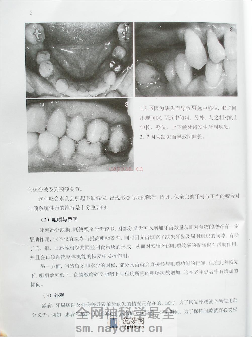 部分活动义齿技术－设计与制作 - 第13页预览图