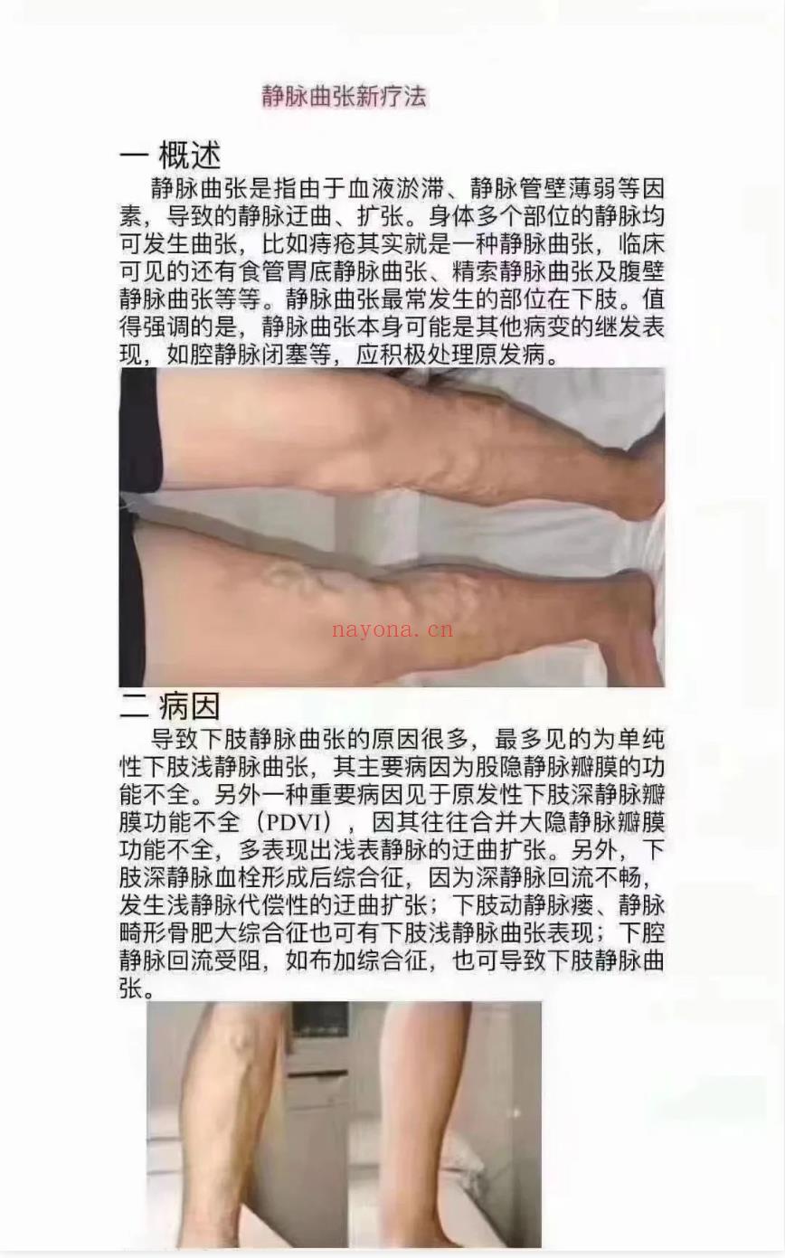 静脉曲张膏配方原价二万技术