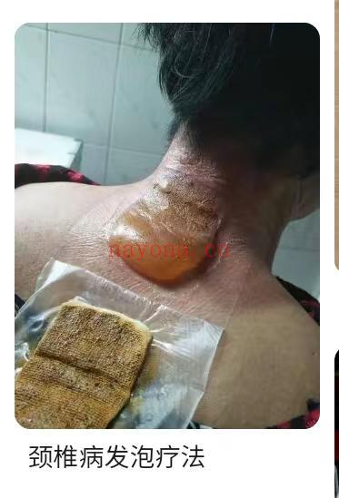 蒙医拔毒愈痛神膏