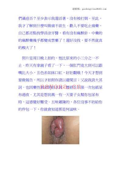 痔疮记.pdf