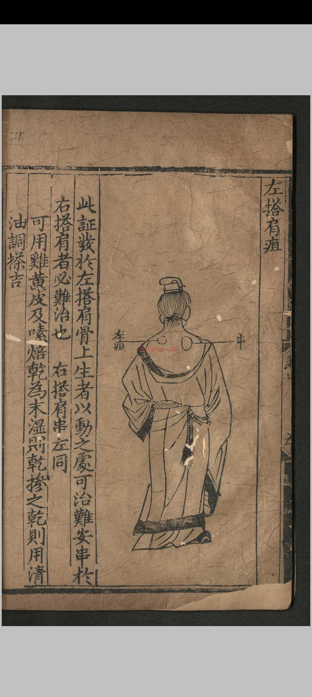 寿域神方.四卷 欠1-2卷.朱权