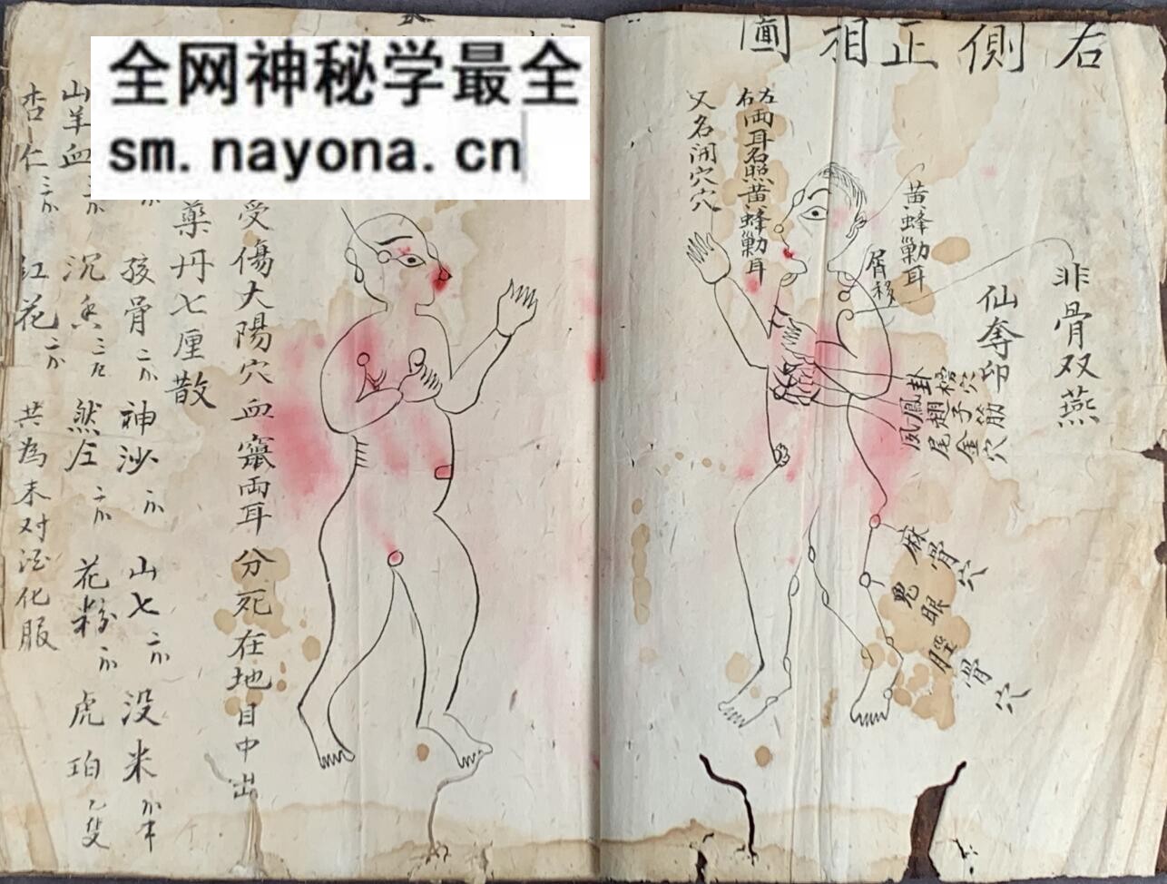 《梅山张五郎跌打医书》