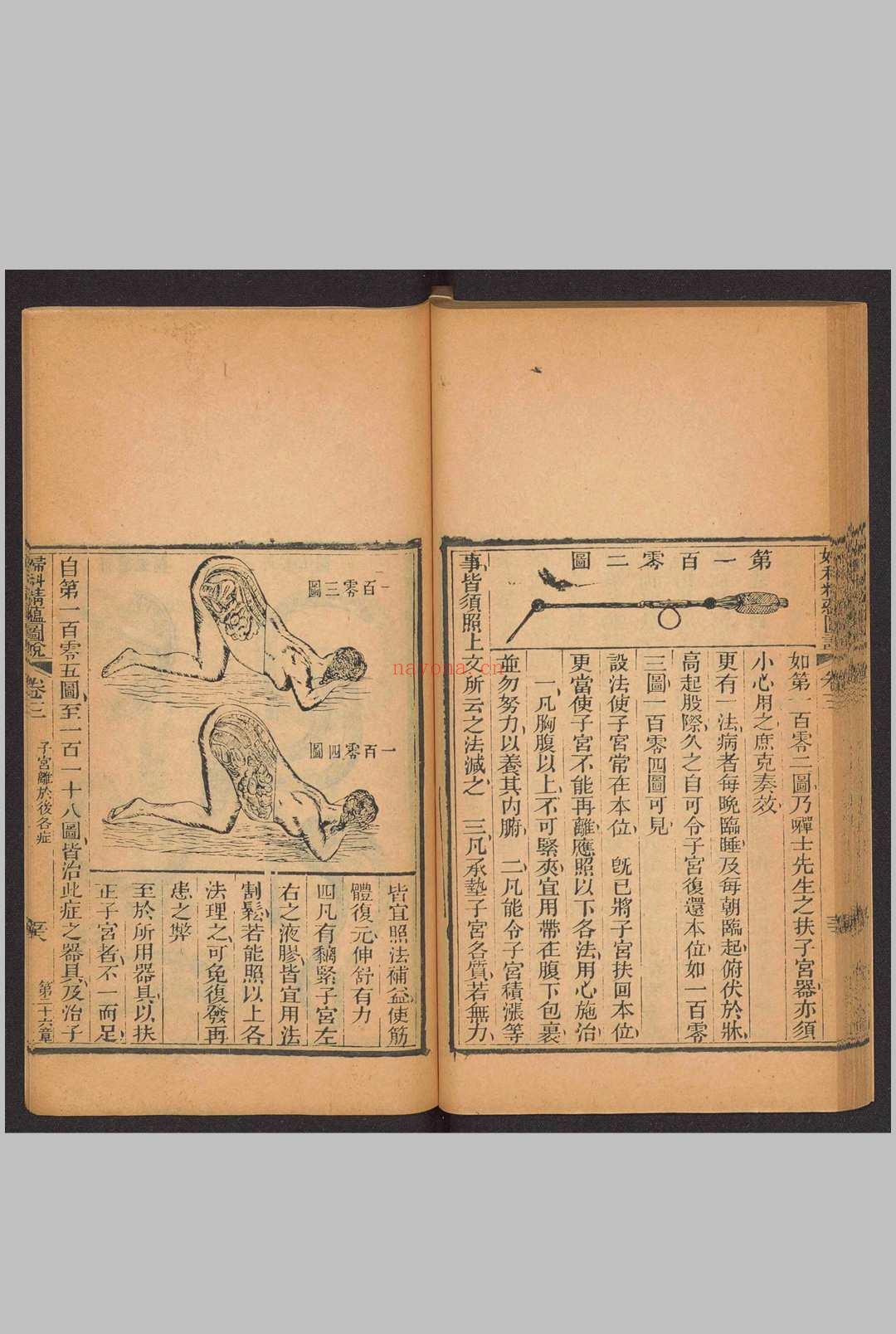 妇科精蕴图说 5卷 光绪15年(1889)羊城博济医局藏版