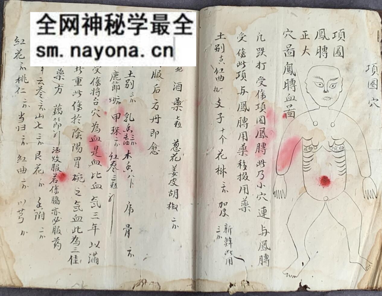 《梅山张五郎跌打医书》