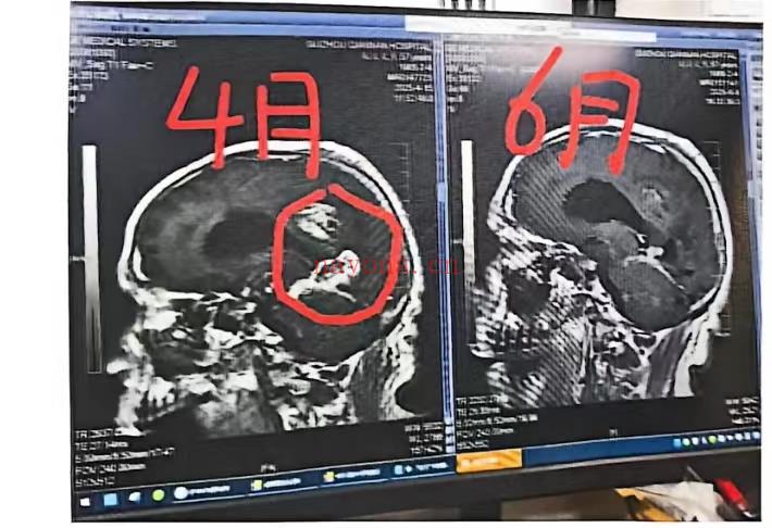 何云2025年精英现场交流会癌症秘方
