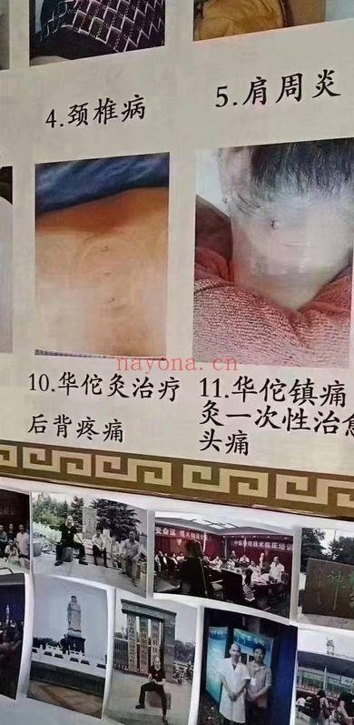 《华佗镇痛灸》实操视频1集+方子
