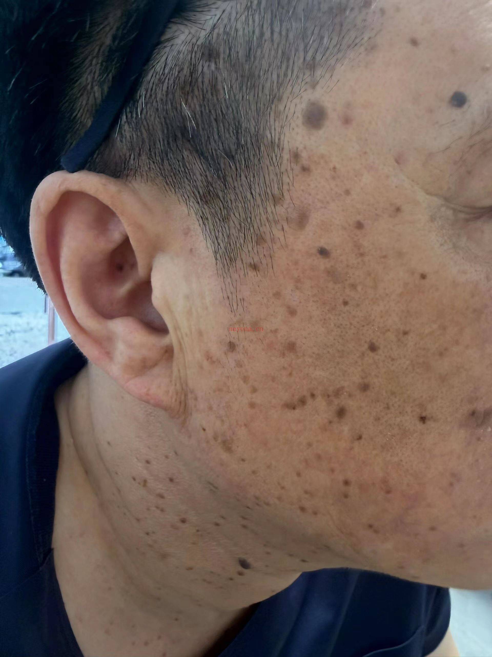 疣类特效方