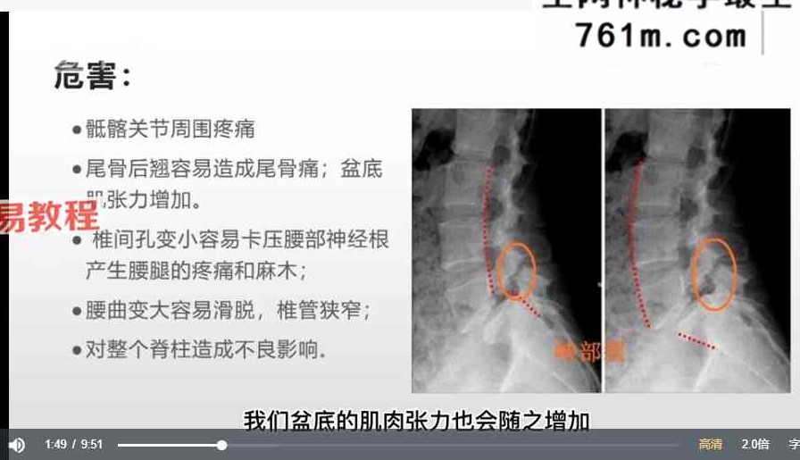 刘学产康骨盆矫正、理论+实操11节课视频