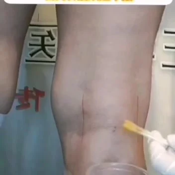 《神奇的古老中医绝技一个穴位一根针高血脂高血压风湿中医针灸视频》