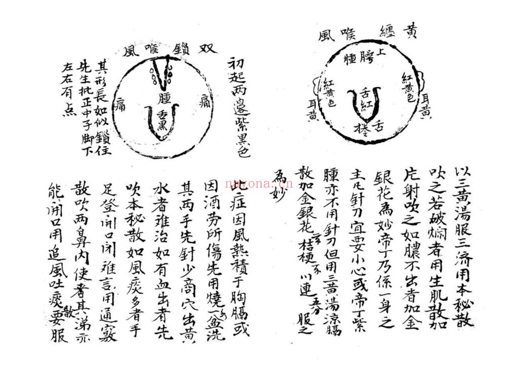 《咽喉秘传》